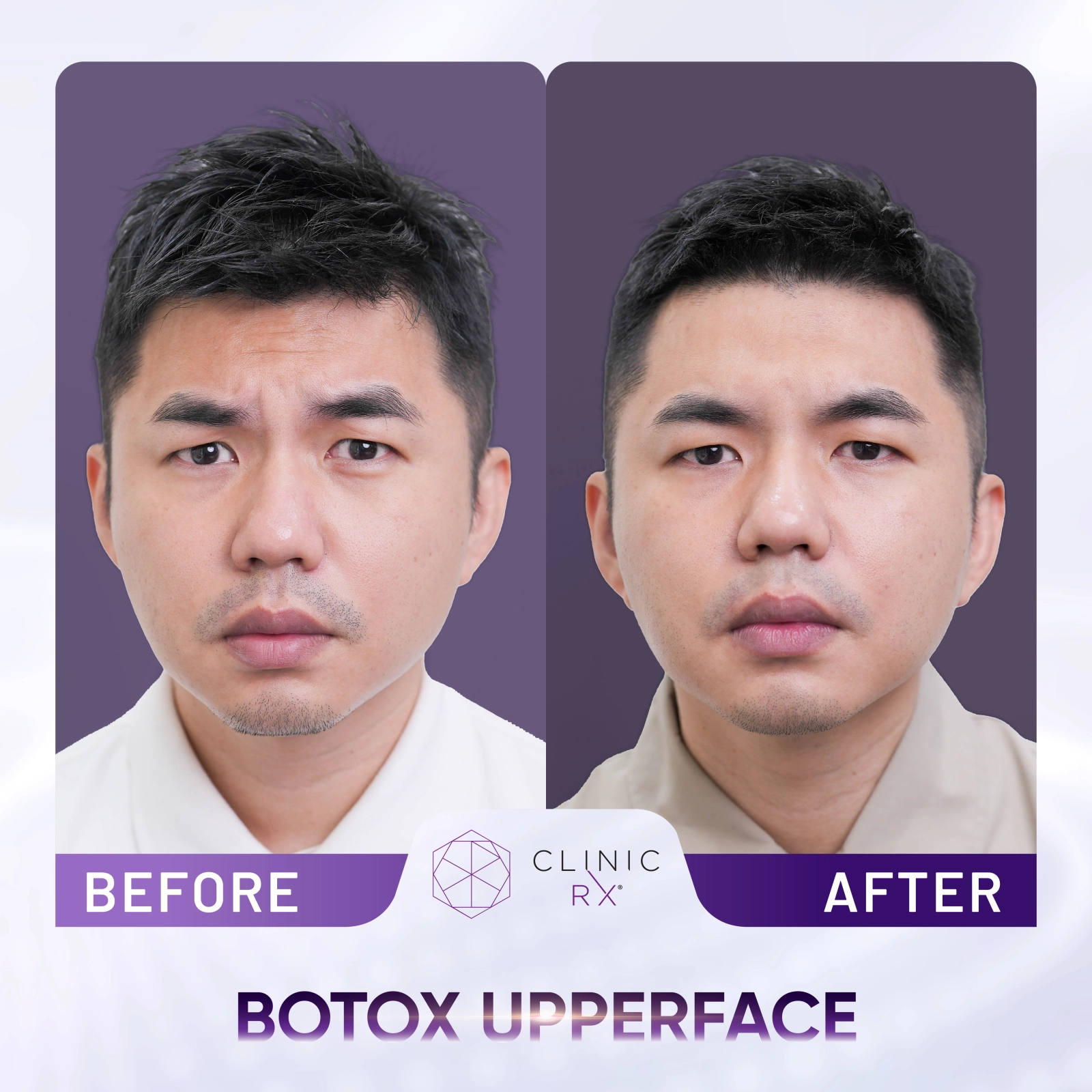 Botox before and after result JB Malaysia 4